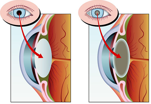 Незрелая катаракта глаз — лечение и симптомы