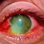 Ожоги глаз – виды, первая помощь и лечение ожогов