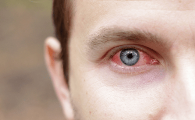 Ожог глаз кварцевой лампой – симптомы, лечение и первая помощь