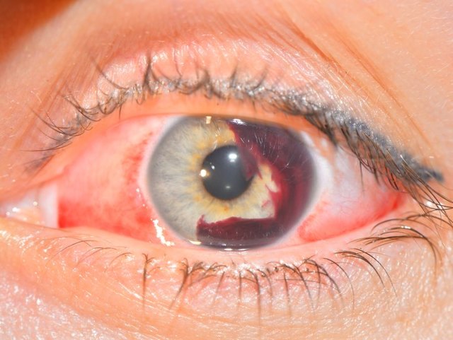 Гифема глаза — причины, симптомы и лечение болезни