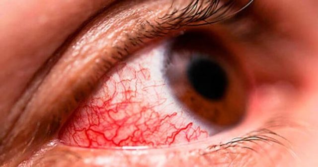 Капли для глаз при конъюнктивите, какие использовать для лечения