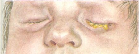 Гонококковый конъюнктивит — симптомы и лечение (гонорея глаз)