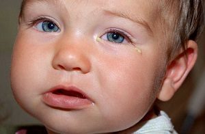 Конъюнктивит у детей до года — причины, симптомы и лечение