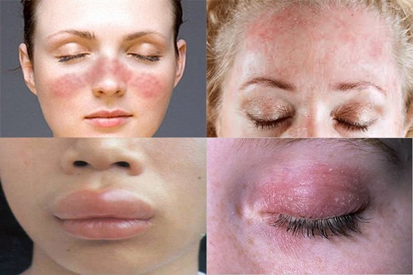 Аллергия на косметику на глазах, что делать – симптомы и лечение