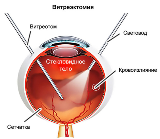 Заболевание дистрофия сетчатки глаза - что это такое?