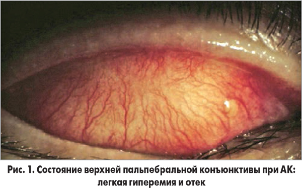 Аллергический конъюнктивит глаз – симптомы и лечение