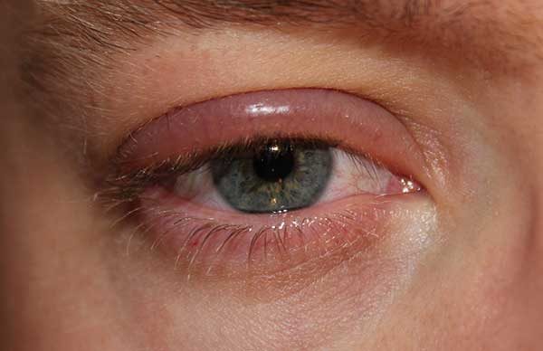 Аллергия на веках глаз – причины, симптомы и лечение, мази от аллергии