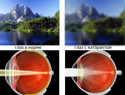 Заднекапсулярная катаракта — причины, симптомы и профилактика