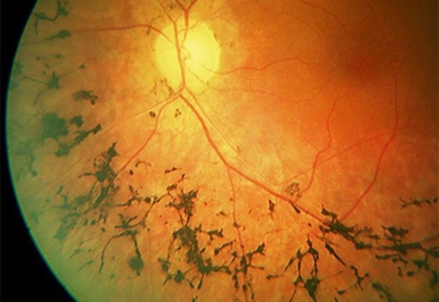 Пигментный ретинит – причины, симптомы и лечение