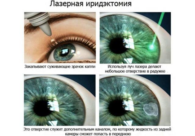 Глаукома – причины, симптомы, лечение и профилактика (фото)