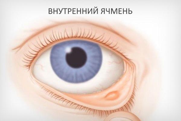 Внутренний ячмень на глазу – причины, симптомы и лечение (фото)