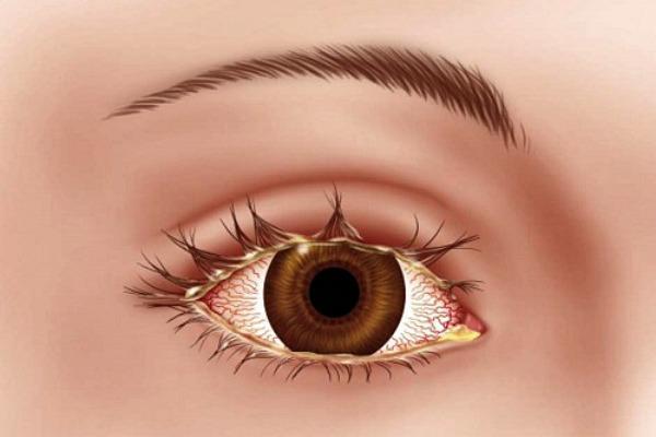 Блефароконъюнктивит глаз – причины, симптомы и лечение (фото)