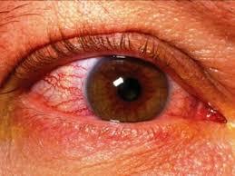 Отек зрительного нерва – причины, симптомы и лечение отека