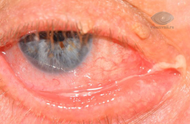 Боль в углу глаза у переносицы – причины и лечение
