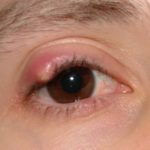 Как предотвратить ячмень на глазу — профилактика ячменя