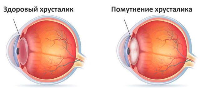 Выпадение полей зрения (причины и лечение)
