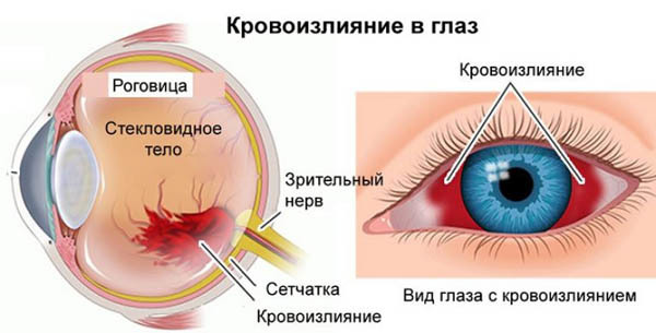 Как можно укрепить сосуды глаз?