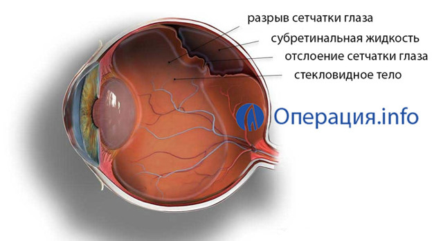Виды операций при отслоении сетчатки глаза и послеоперационный период