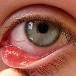 Отслойка стекловидного тела глаза – причины, симптомы и лечение