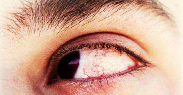 Деструкция стекловидного тела глаза – симптомы и лечение
