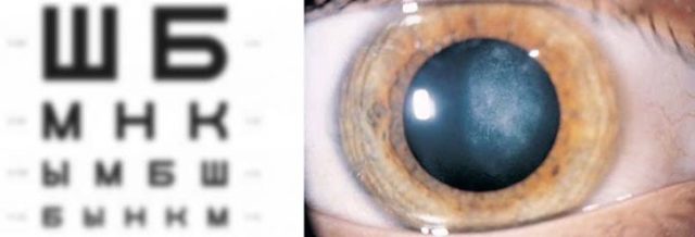 Начальная стадия катаракты — симптомы и лечение. Что делать при появлении начальной катаракты