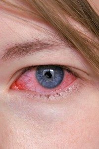 Кровоизлияние в склеру глаза – причины, симптомы и лечение