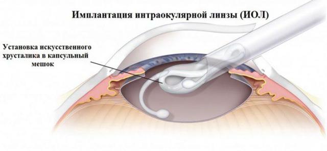 Как восстановить зрение при дальнозоркости, способы по улучшению и исправлению зрения