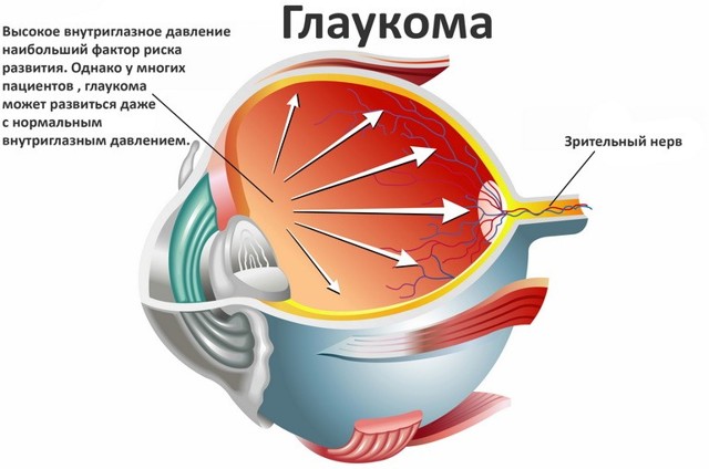 Операция глаукомы – виды, как делается и последствия