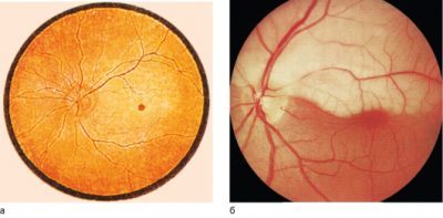 Ангиопатия сетчатки глаза при беременности — лечение