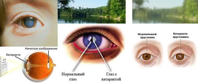 Нарушение сумеречного зрения – симптомы и лечение. Что отвечает за зрение в сумерках