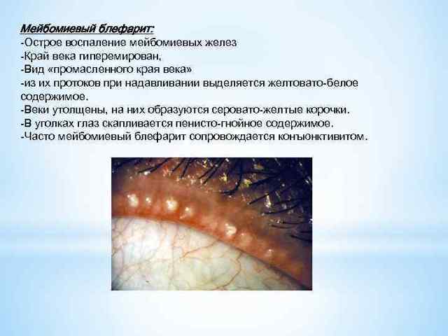 Мейбомиевый блефарит – причины, симптомы и лечение (фото)