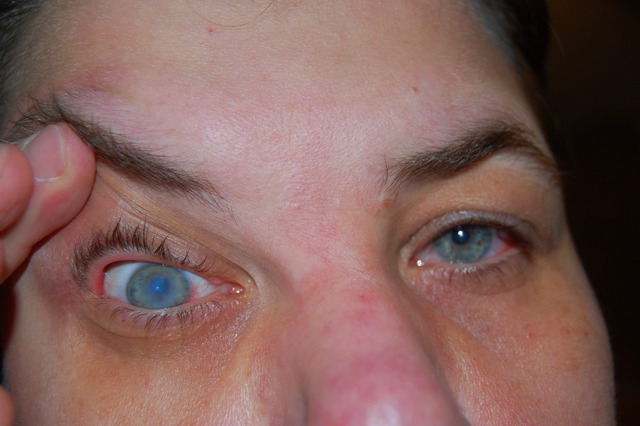 Отек роговицы глаза – симптомы и лечение