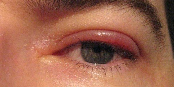 Аллергия на нарощенные ресницы – причины, симптомы и лечение