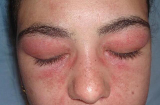 Аллергия на нарощенные ресницы – причины, симптомы и лечение