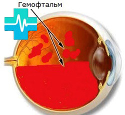 Кровоизлияние в глаз – причины и лечение, что делать при кровоизлиянии