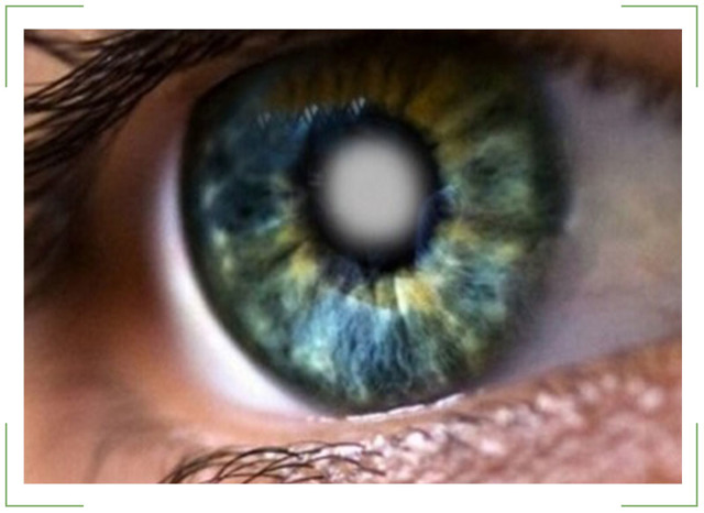 Осложненная катаракта глаз — причины, симптомы и лечение. Стадии заболевания