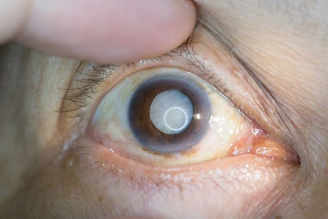 Диабетическая катаракта — симптомы и лечение (операция, фото). Профилактика катаракты при диабете
