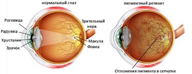 Пигментный ретинит – причины, симптомы и лечение