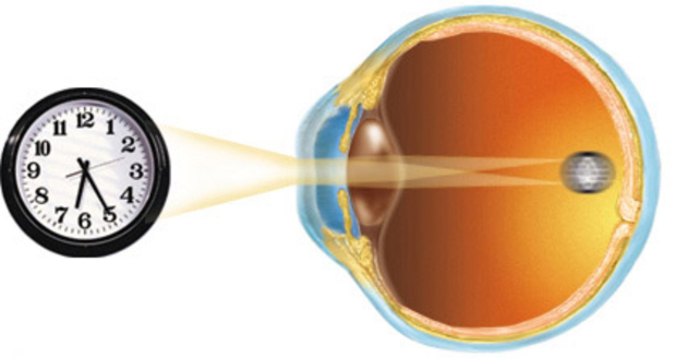 Глазные капли при астигматизме — лечение без операции (витамины)