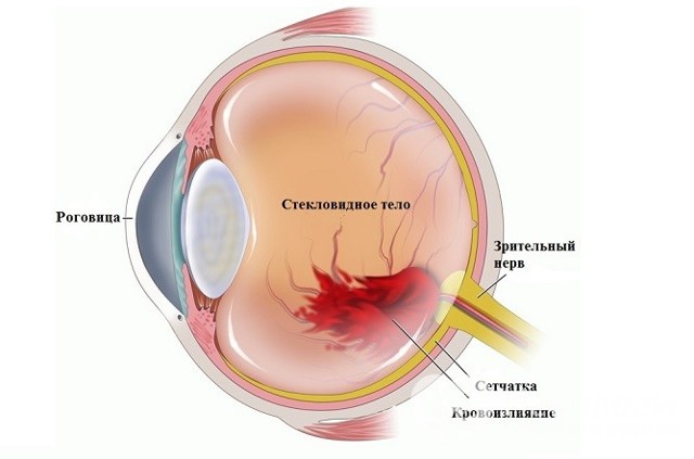 Гемофтальм глаза – причины, симптомы и лечение (фото). Гемофтальм частичный и тотальный.