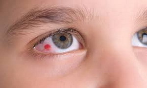 Кровоизлияние в глазу у новорожденного – что делать и как лечить