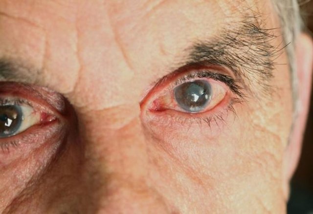 Катаракта глаза. Причины, симптомы и лечение катаракты