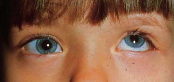 Паралитическое косоглазие у детей — причины, лечение и профилактика