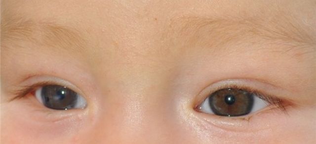 Врожденная катаракта у детей и взрослых – лечение, причины и симптомы, виды врожденной катаракты глаза