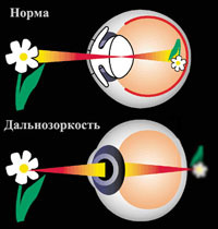 Лазерная коррекция зрения при дальнозоркости (операция)