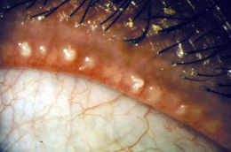 Мейбомиевый блефарит – причины, симптомы и лечение (фото)