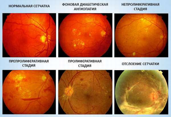 Ангиопатия сетчатки глаза – причины, симптомы и лечение