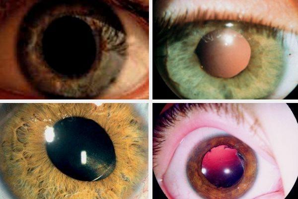 Афакия глаза, что это такое: признаки, симптомы и лечение
