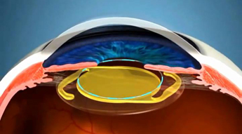 Замена хрусталика глаза при катаракте – стоимость операции (фото, видео)