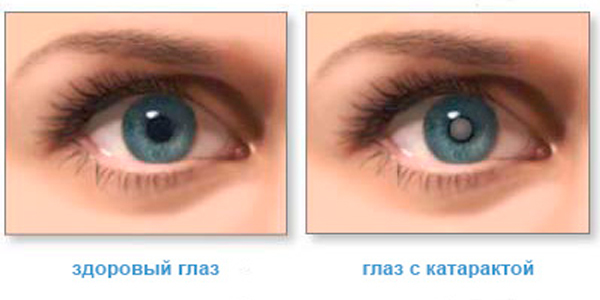 Незрелая катаракта глаз — лечение и симптомы